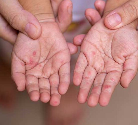 Measles Treatment